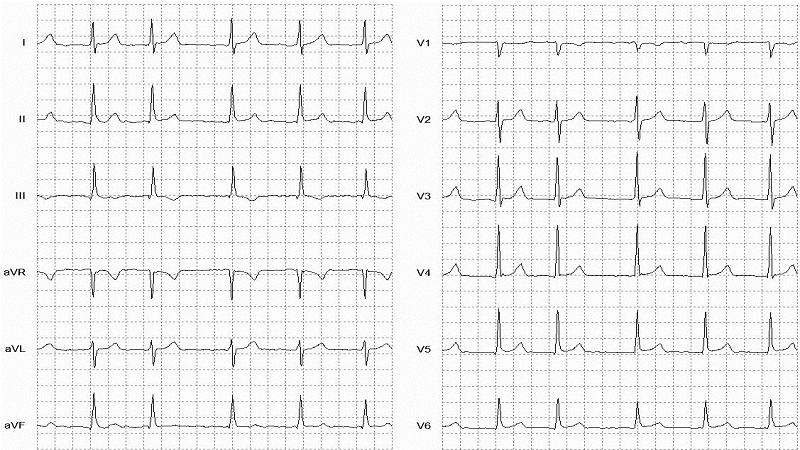 Atrial Fibrillation 12 Lead EKG_fig3